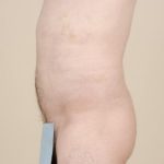 Liposuction Before & After Patient #1651