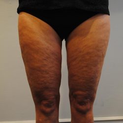 Liposuction Before & After Patient #1026