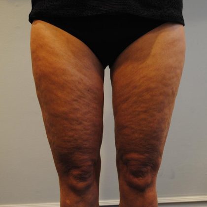 Liposuction Before & After Patient #1026