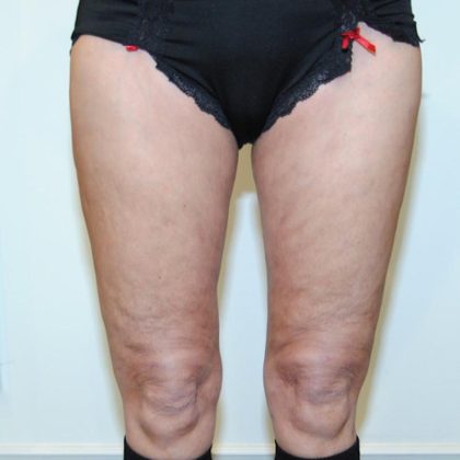 Liposuction Before & After Patient #1026