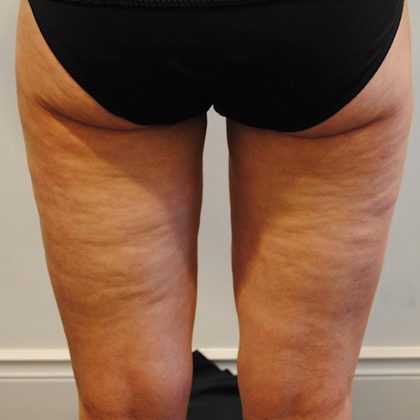 Liposuction Before & After Patient #1026