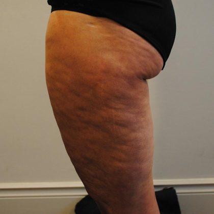 Liposuction Before & After Patient #1026