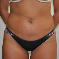 Liposuction Before & After Patient #1027