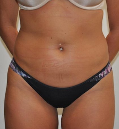 Liposuction Before & After Patient #1027