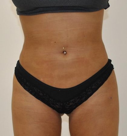 Liposuction Before & After Patient #1027
