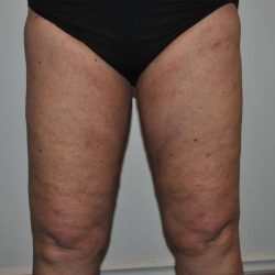 Liposuction Before & After Patient #1028