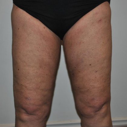 Liposuction Before & After Patient #1028