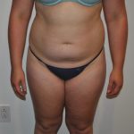 Liposuction Before & After Patient #1029