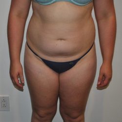 Liposuction Before & After Patient #1029