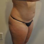Liposuction Before & After Patient #1029