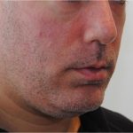 Mandibular Jaw Implants Before & After Patient #1630