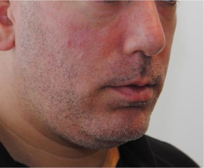 Mandibular Jaw Implants Before & After Patient #1630