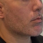 Mandibular Jaw Implants Before & After Patient #1630