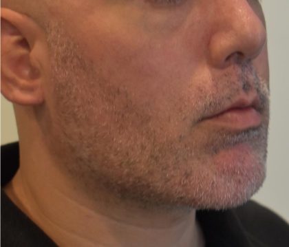 Mandibular Jaw Implants Before & After Patient #1630