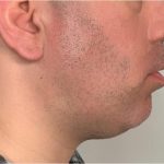 Mandibular Jaw Implants Before & After Patient #1630