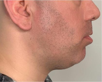 Mandibular Jaw Implants Before & After Patient #1630