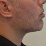 Mandibular Jaw Implants Before & After Patient #1630