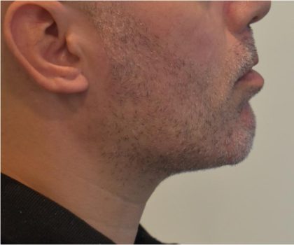 Mandibular Jaw Implants Before & After Patient #1630