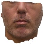 Mandibular Jaw Implants Before & After Patient #1631