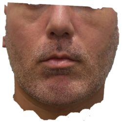 Mandibular Jaw Implants Before & After Patient #1631