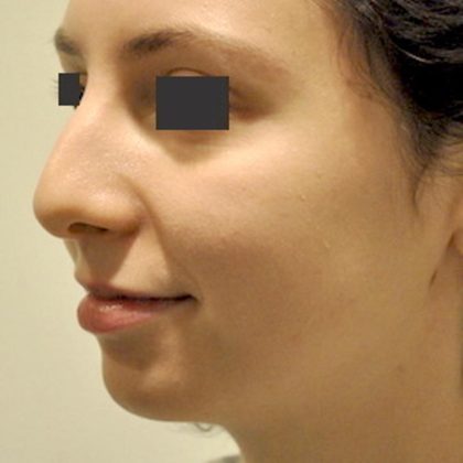 Mandibular Jaw Implants Before & After Patient #1632