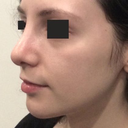 Mandibular Jaw Implants Before & After Patient #1632