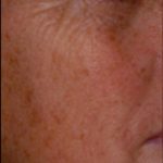 Micro Laser Peel Before & After Patient #1644