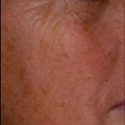 Micro Laser Peel Before & After Patient #1644