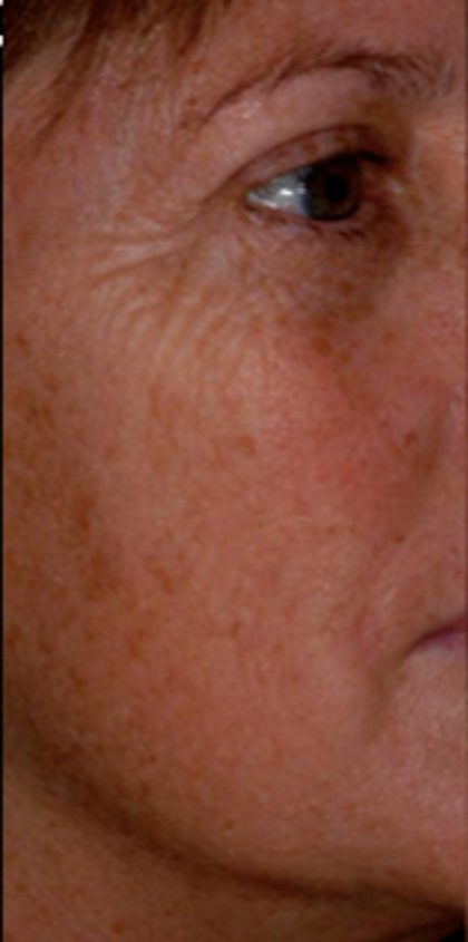 Micro Laser Peel Before & After Patient #1644