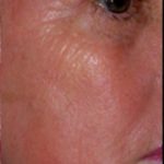 Micro Laser Peel Before & After Patient #1644