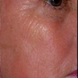 Micro Laser Peel Before & After Patient #1644