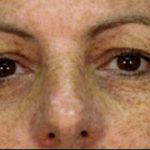 Micro Laser Peel Before & After Patient #1645