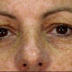 Micro Laser Peel Before & After Patient #1645