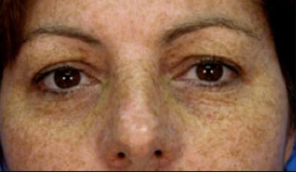 Micro Laser Peel Before & After Patient #1645