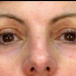 Micro Laser Peel Before & After Patient #1645
