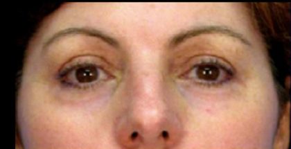 Micro Laser Peel Before & After Patient #1645