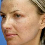 Micro Laser Peel Before & After Patient #1646