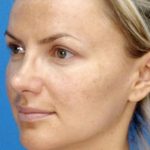 Micro Laser Peel Before & After Patient #1646