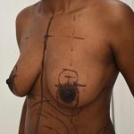 Natural Breast Augmentation Before & After Patient #1031