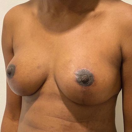 Natural Breast Augmentation Before & After Patient #1031