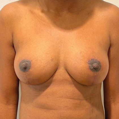 Natural Breast Augmentation Before & After Patient #1031