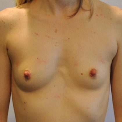 Natural Breast Augmentation Before & After Patient #1032