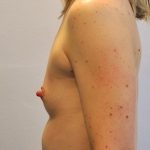 Natural Breast Augmentation Before & After Patient #1032