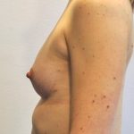 Natural Breast Augmentation Before & After Patient #1032