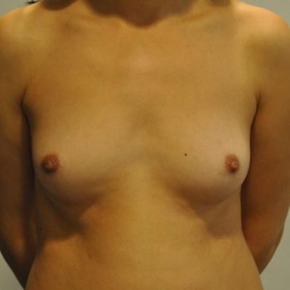 Natural Breast Augmentation Before & After Patient #1033