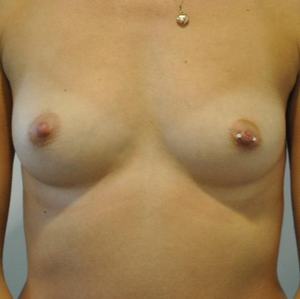 Natural Breast Augmentation Before & After Patient #1034