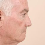 Neck Lift Before & After Patient #1633