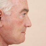 Neck Lift Before & After Patient #1633