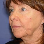 Neck Lift Before & After Patient #1634