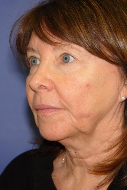 Neck Lift Before & After Patient #1634